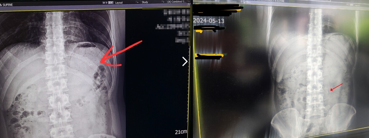 소고기에서 나온 바늘을 삼킨 사연자의 남편 X레이 사진 [ 사진 = 보배드림 갈무리 ]