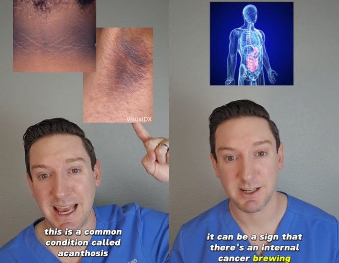 한국인은 비교적 잘 발병하지 않는 것으로 알려진 피부암을 앓는 환자가 국내에서 급증하면서 암을 조기에 확인할 수 있는 증상에 대한 관심이 커지고 있다. (사진= 틱톡 갈무리) *재판매 및 DB 금지 / 사진 = 뉴시스