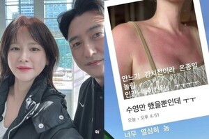 안정환 아내 이혜원, 화상 심각 